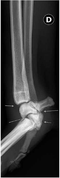 examen radio de panarthrodèse