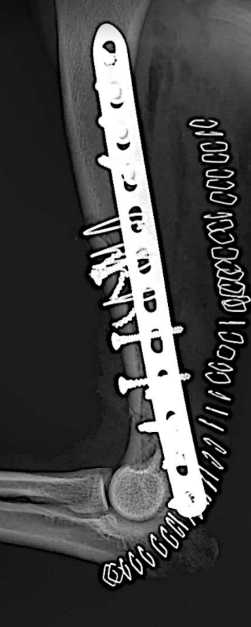 fracture de l'humerus par morsure