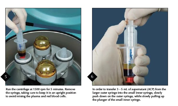 Explication de la technique ACP - vétérinaire Orthovet