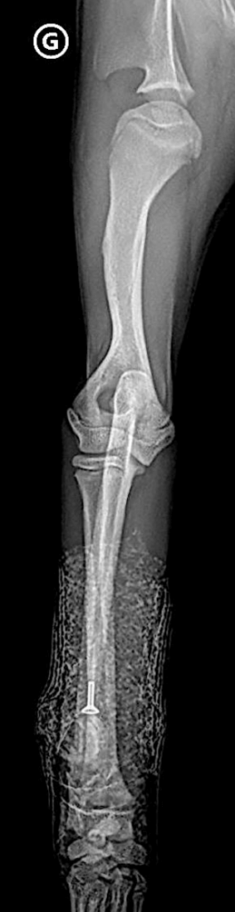 Fracture du condyle humeral lateral