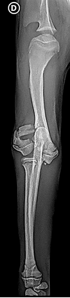 Fracture du condyle humeral lateral