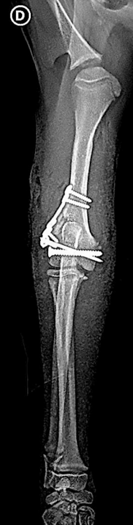 Fracture du condyle humeral lateral