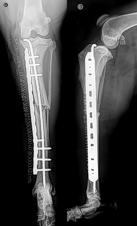 Chirurgie orthopédique d'une fracture du tibia par montage combiné ...