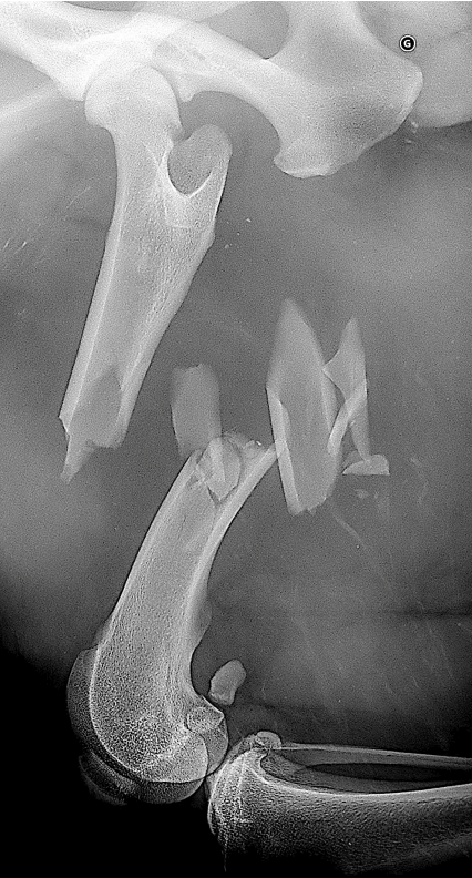 fracture complexe du fémur