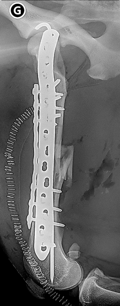 fracture complexe du fémur