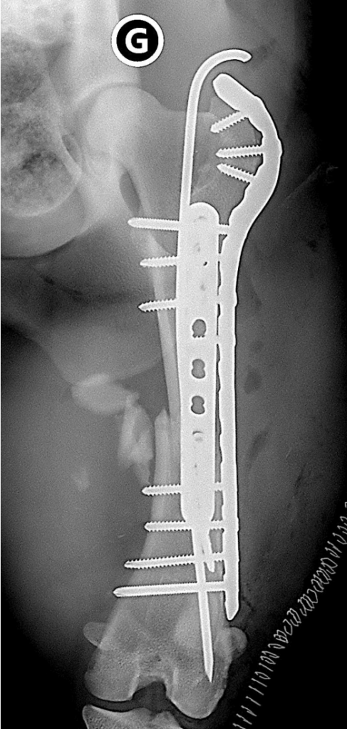 fracture complexe du fémur