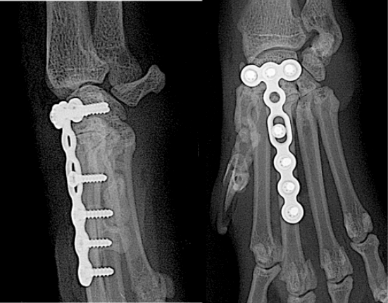 Arthrodèse partielle du carpe