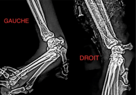 Arthrodèse partielle du carpe