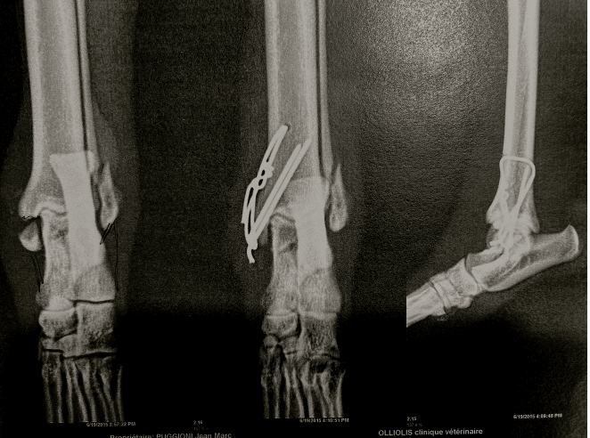 Arthrodèse tibia-tarsienne de sauvetage