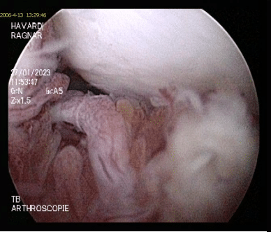 vues arthroscopiques per-opératoires