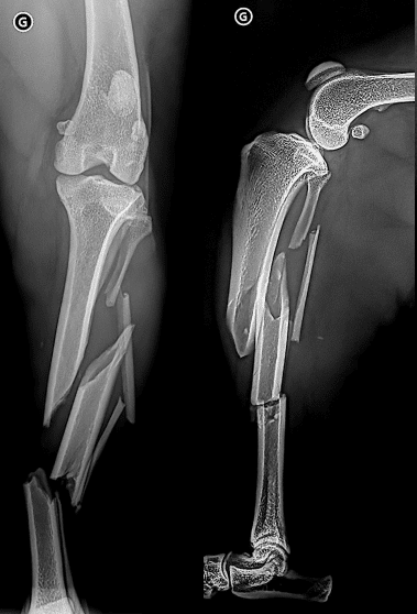 chirurgie orthopédique complexe fracture comminutive avec trois fragments diaphysaires